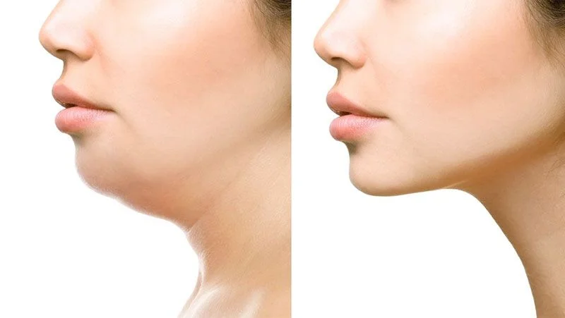 Cervicoplastia