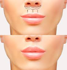 LipLift
